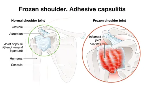 Ishitani Health Center - What Is Frozen Shoulder and How Can Chiropractic Care and Acupuncture Help?